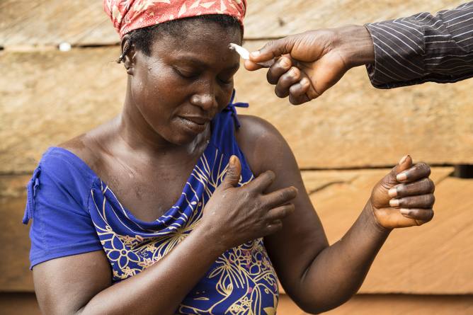 Imagen de Día mundial de la lepra: La lepra se combate a través de la investigación y el diagnóstico temprano